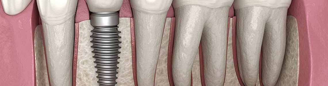 Dental-implant-illustration