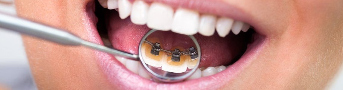 aparat-dentar-ieftin